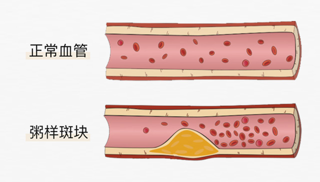 血栓是心梗、脑梗的元凶，很容易找上这些人