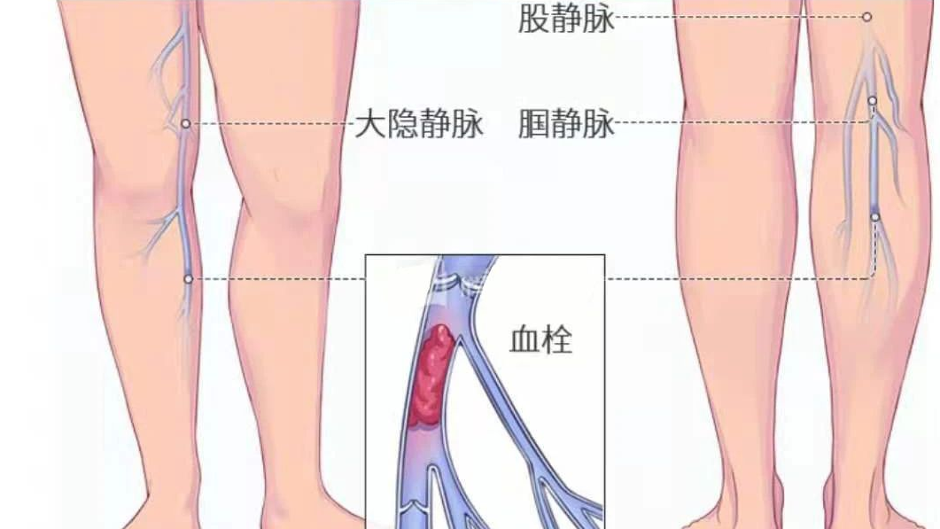 深静脉血栓类似病症的认识与区分