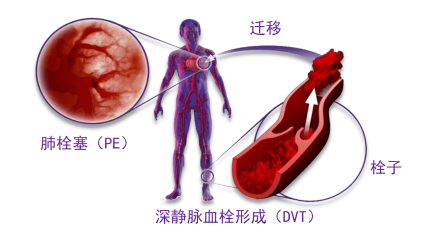 骨科术后重点关注的问题—VTE，该如何防治？