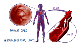 血栓疾病当警惕 日常预防要重视