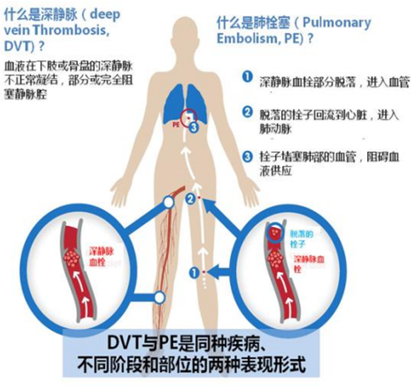 肿瘤患者VTE的预防