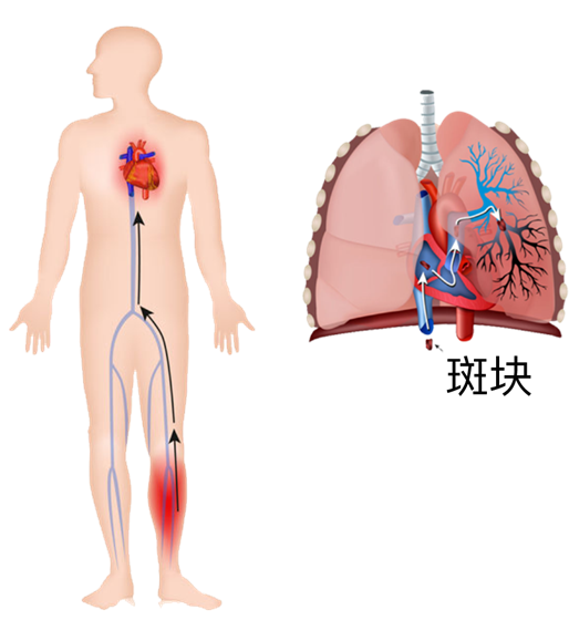 血栓是心梗、脑梗的元凶，很容易找上这些人