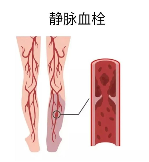 血栓是心梗、脑梗的元凶，很容易找上这些人