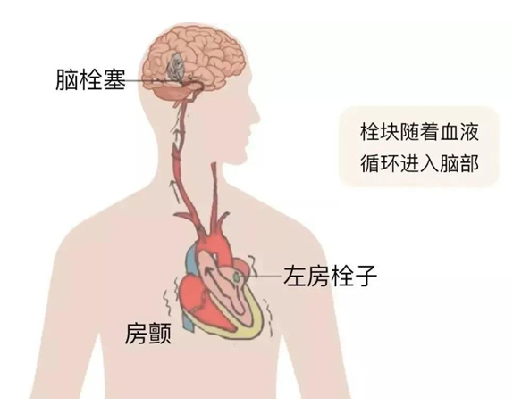 血栓是心梗、脑梗的元凶，很容易找上这些人