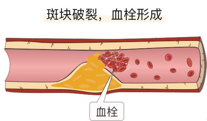 血栓是心梗、脑梗的元凶，很容易找上这些人