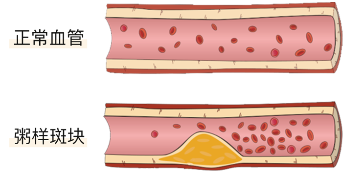 血栓是心梗、脑梗的元凶，很容易找上这些人