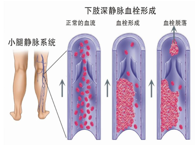 警惕！这个全球“第三大心血管杀手”，我们该如何应对？