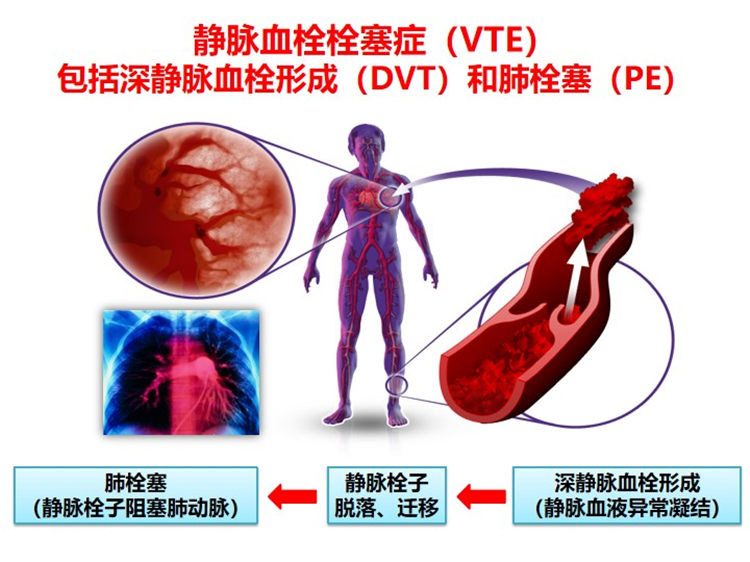 世界血栓日 | 拴不住，动起来