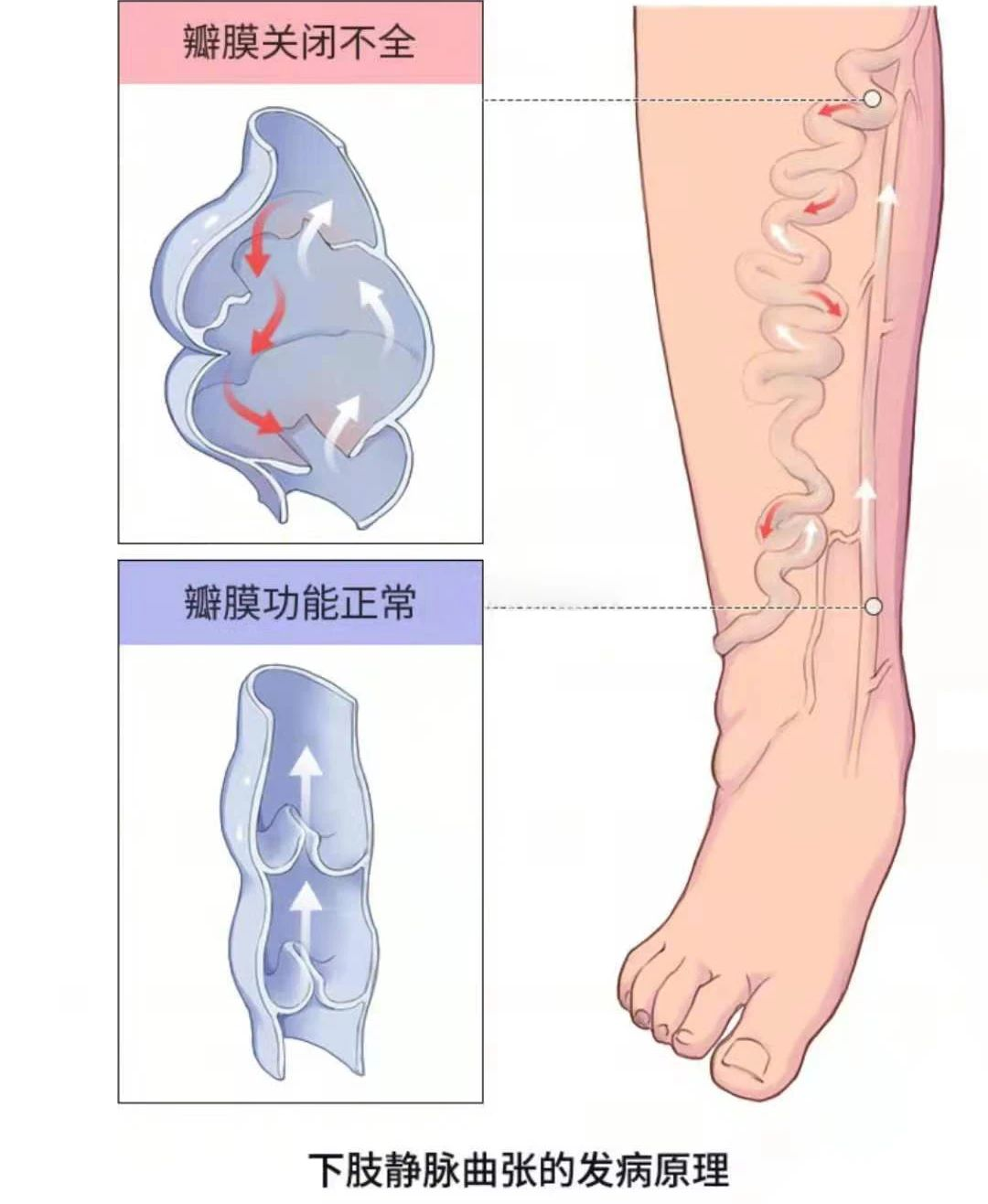 深静脉血栓类似病症的认识与区分