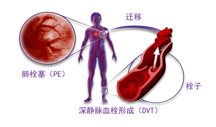 骨科术后重点关注的问题—VTE，该如何防治？