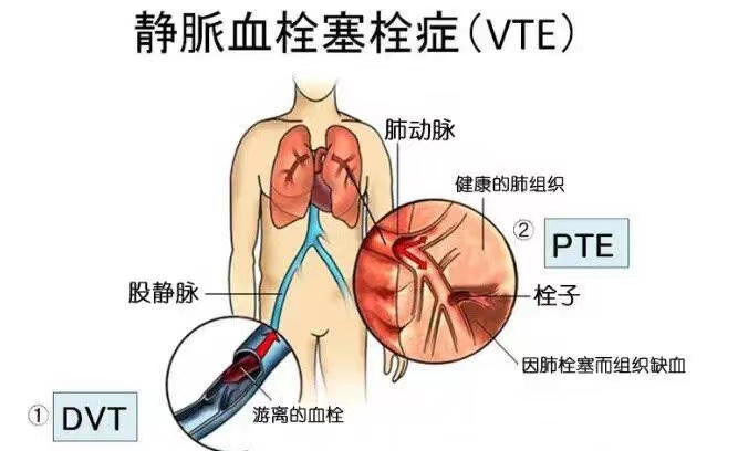 哪些人容易发生静脉血栓栓塞症（VTE）