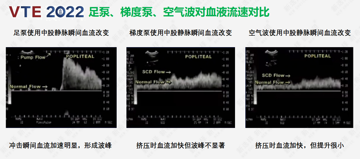 围术期患者VTE的预防，只知道抗凝可不行