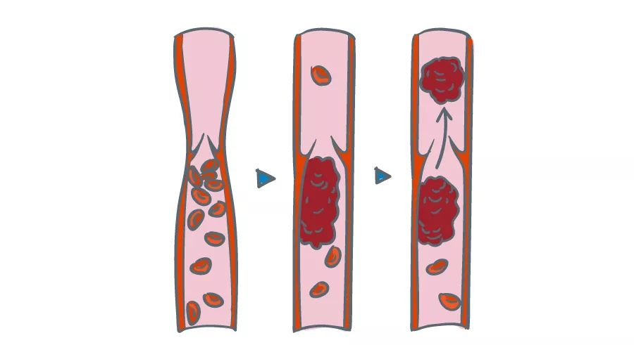 深静脉血栓能致命，防治“大法”要了解！