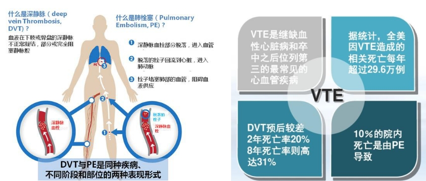 VTE的危害您了解吗？