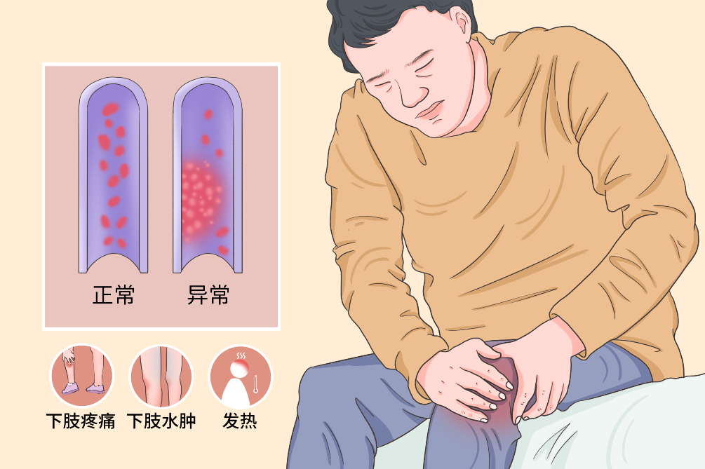 VTE的危害您了解吗？