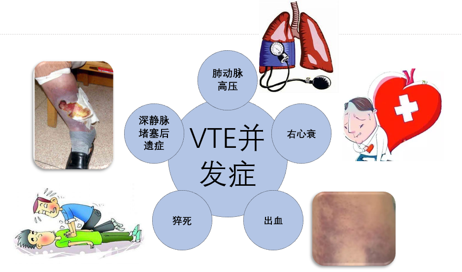 VTE的危害您了解吗？