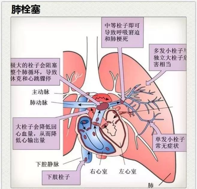 “沉默的杀手”——肺栓塞