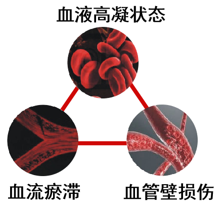 静脉疾病的患难兄弟