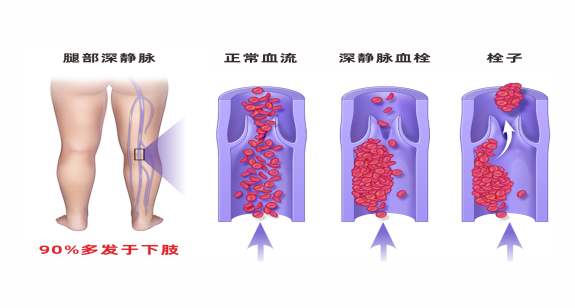 静脉疾病的患难兄弟