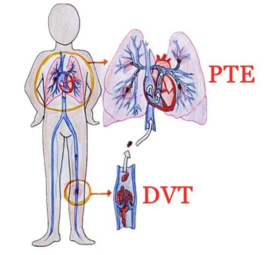 围生期静脉血栓栓塞症（VTE）